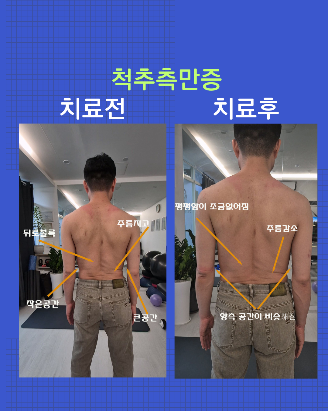 척추측만증 치료 전후 - 후면